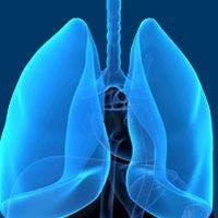 Tislelizumab Frontline Combo Improves PFS in Nonsquamous NSCLC