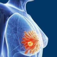 Adjuvant Trastuzumab Emtansine Approved in UK for HER2+ Early Breast Cancer