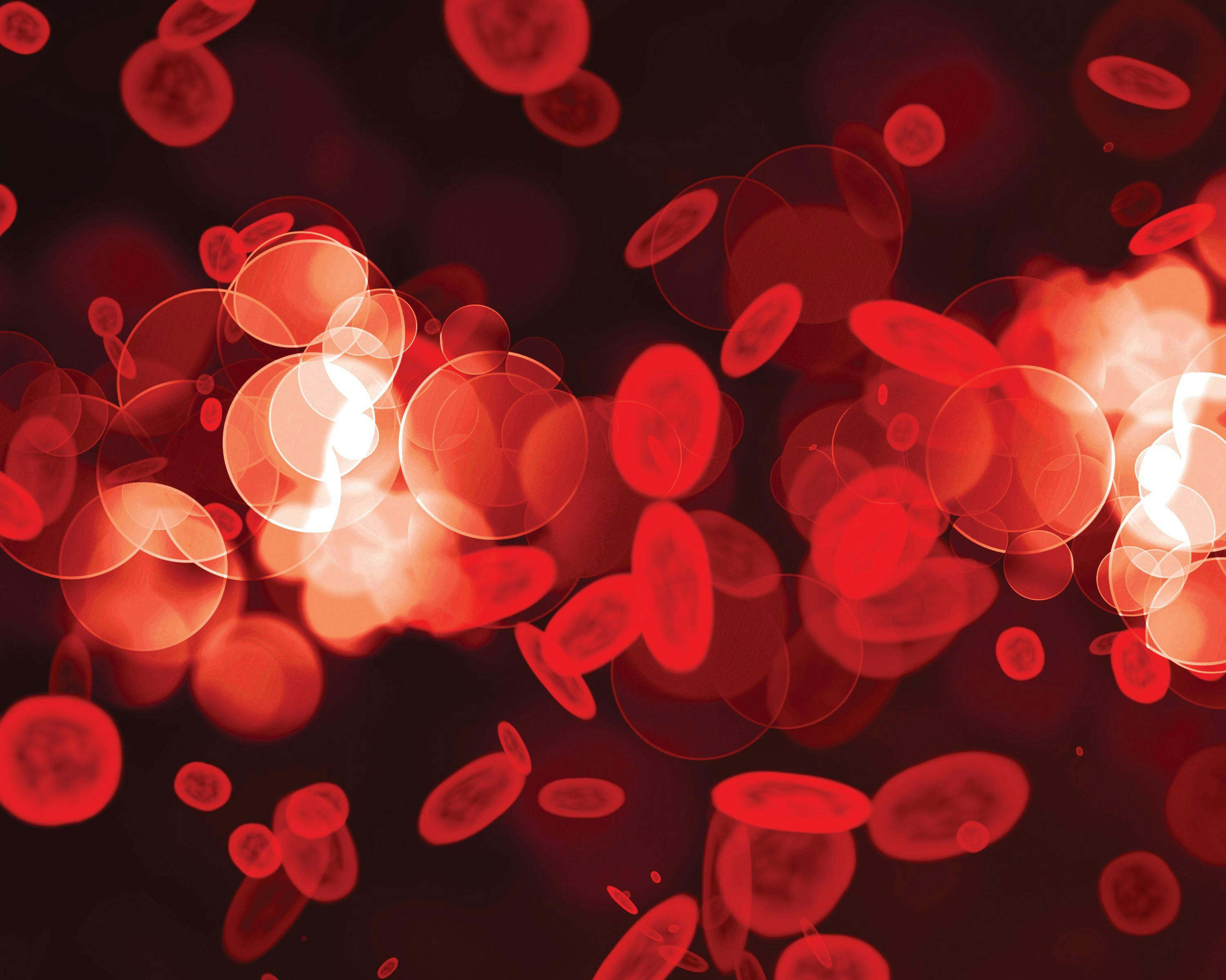Bomedemstat Demonstrates Early Promise in Advanced Myelofibrosis