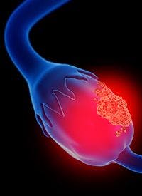 Anlotinib/Niraparib Combo in Platinum-resistant 

Ovarian Cancer | Image Credit: © Lars Neumann - 

stock.adobe.com