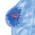 Extended Adjuvant Neratinib Improves DFS in Phase III Breast Cancer Study
