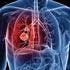 MAGE-A3 Antigen-Specific Vaccine Fails to Extend DFS in NSCLC