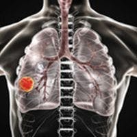 The National Medical Products Administration of China has approved sunvozertinib (DZD9008) for use in adult patients with locally advanced or metastatic non–small cell lung cancer (NSCLC) harboring EGFR exon 20 insertion mutations whose disease has progressed on or following platinum-based chemotherapy.