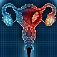 Addition of Bevacizumab to Pembrolizumab Improves Responses in Epithelial Ovarian Cancer