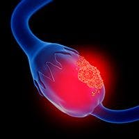 3d illustration of ovarian cancer | Image Credit: © Lars Neumann - stock.adobe.com