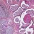 Gene Signatures Help Predict Aggressive Prostate Cancer