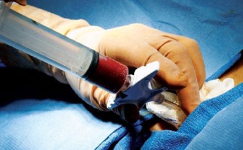 How to Perform the Perfect Bone Marrow Biopsy