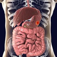 Initial Treatment With Lenvatinib Prolongs Survival for Patients With Hepatocellular Carcinoma