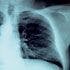 ASTRO Issues Guidelines for Palliative Lung Cancer Care