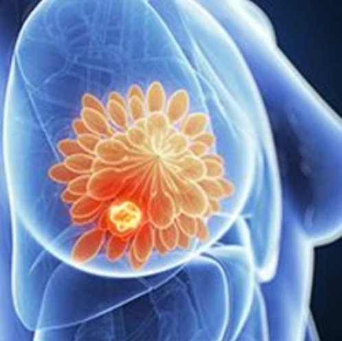 Exploring Recent Developments in the Treatment of Patients with HR+ Metastatic Breast Cancer