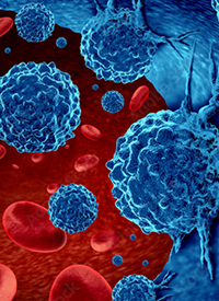 Chronic Lymphocytic Leukemia    | Image Credit: ©freshidea - stock.adobe.com