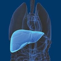 Tumor Burden Limits Liver Transplant Feasibility for HCC