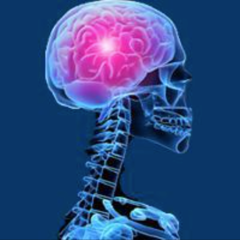 ASTRO Releases Clinical Guidelines for Radiation Therapy in IDH-Mutant Glioma