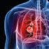 EGFR Inhibitors Continue March in Mutated NSCLC