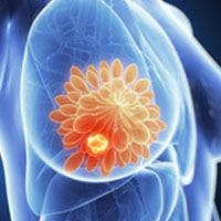 Neoadjuvant and Adjuvant Therapy Elicit Similar Efficacy in Early-Stage HER2+ Breast Cancer