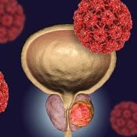 Six months of enzalutamide monotherapy in combination with salvage radiation therapy postponed prostate-specific antigen  progression compared with SRT alone in men with PSA-recurrent, high-risk prostate cancer. 