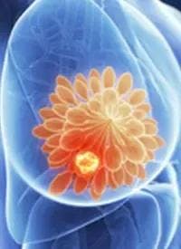 3d rendered illustration - breast cancer | Image Credit: © Sebastian Kaulitzki - stock.adobe.com