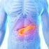 MM-398 Receives Fast Track Designation for Advanced Pancreatic Cancer