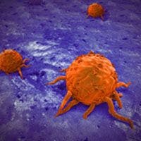 Second Line T-DM1 Worsens Outcomes for HER2+ Breast Cancer in Real-World Study
