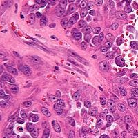 CHMP Recommends Approval of Eribulin for Advanced Liposarcoma