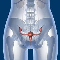 Adjuvant Chemotherapy Reduces Distant Recurrence Risk in Cervical Cancer