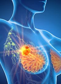 T-DXd in HER2+ Metastatic Breast Cancer | Image Credit: © Axel Kock - stock.adobe.com