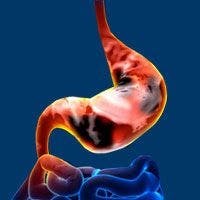 Trastuzumab Beyond Progression Shows Promise in HER2+ Gastric Cancers