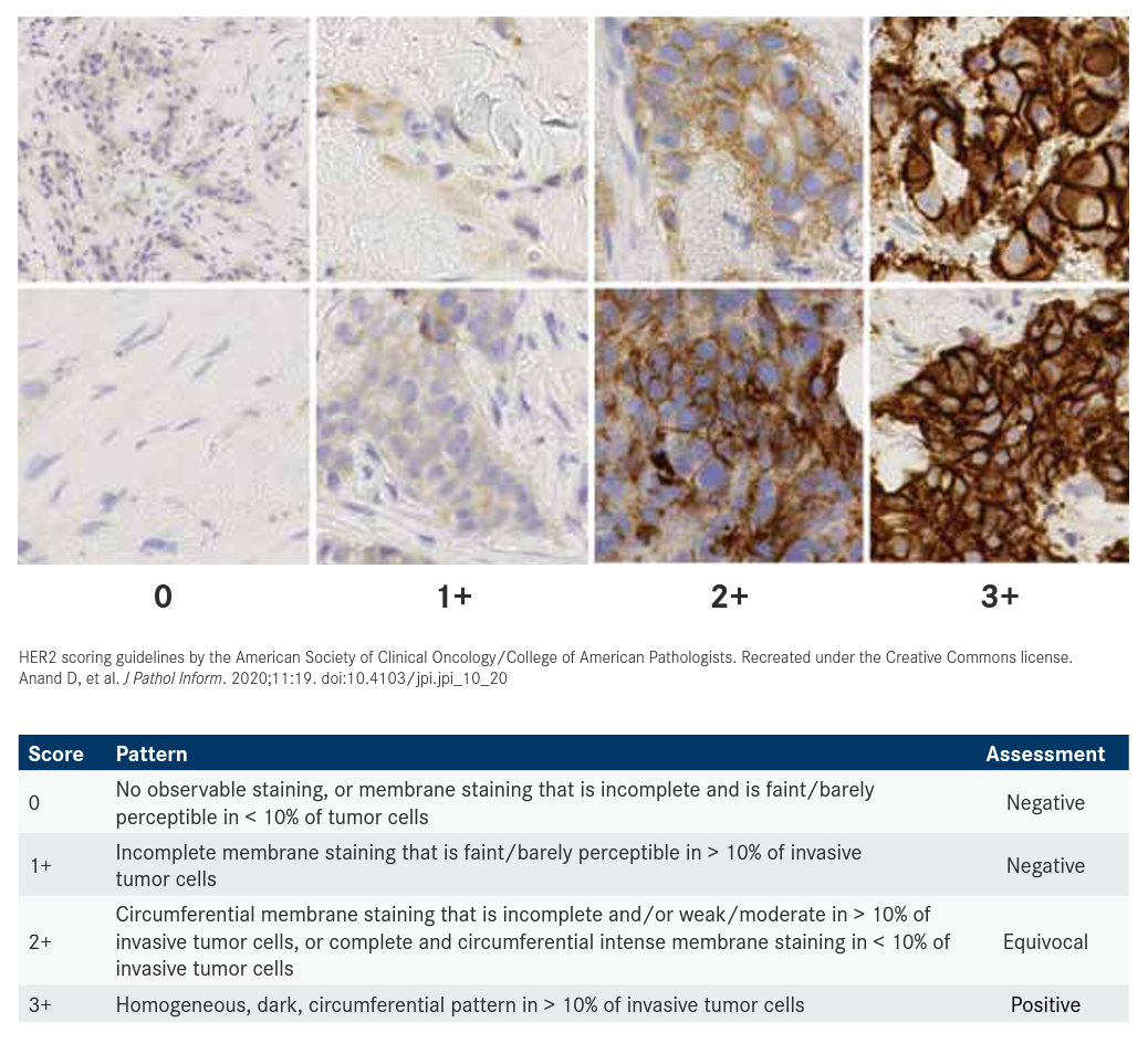 Figure. Examples of HER2 Expression via Immunohistochemistry Staining12