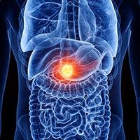 Glecirasib in KRAS G12C–Mutated Pancreatic Cancer | Image Credit: © SciePro - stock.adobe.com