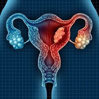 Frontline Bevacizumab Plus Chemotherapy Elicits PFS, OS Benefit in Ovarian Clear Cell Carcinoma