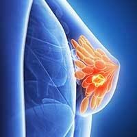 Subcutaneous Trastuzumab Proves Safe and Tolerable in HER2+ Metastatic Breast Cancer