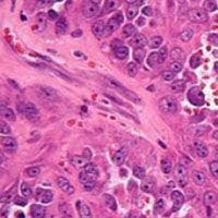 Pembrolizumab Prolongs PFS in Rare Sarcoma Subtypes