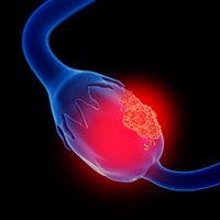 Niraparib Maintenance Extends PFS in Newly Diagnosed Ovarian Cancer 