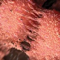 Frontline Immunotherapy Combos Linked With Higher CR Rates Than Anti-VEGF Therapy in mRCC