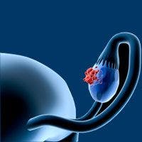 Laparoscopy Plays Predictive Role for Primary Surgery Outcomes in Ovarian Cancer