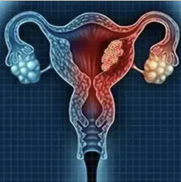 Maintenance selinexor monotherapy was found to improve progression-free survival over placebo in patients with advanced or recurrent endometrial cancer.