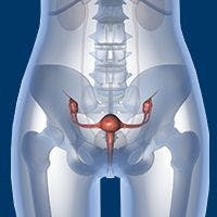 Surgery-Free Alternative Is Favorably Accepted Among Women at Risk of Ovarian Cancer