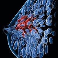 NICE Recommends Trastuzumab Deruxtecan in Advanced HER2+ Breast Cancer 