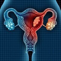 Rucaparib Maintenance Elicits PFS Benefit in Newly Diagnosed Ovarian Cancer