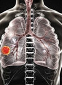 Telisotuzumab vedotin in combination with erlotinib induced promising outcomes in patients with advanced, EGFR-mutated, c-MET-positive non–small cell lung cancer who were contraindicated for surgery or other approved therapies.