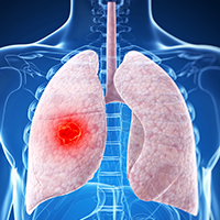 First-Line Extensive-Stage Small Cell Lung Cancer: Examining the New Role of Combination Chemotherapy and Immunotherapy