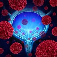 The addition of tislelizumab to nab-paclitaxel demonstrated efficacy and safety in patients with high-risk non–muscle invasive bladder cancer.