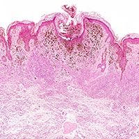 Merkel Cell Carcinoma Study Matches TMB With Disease Drivers