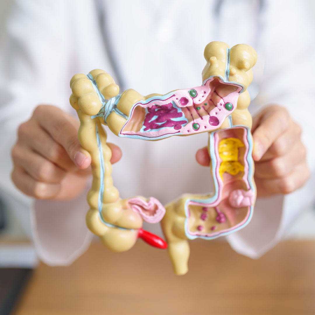 Doctor with human Colon anatomy model. Colonic disease, Large Intestine, Colorectal cancer, Ulcerative colitis, Diverticulitis, Irritable bowel syndrome, Digestive system and Health concept | Image Credit Panuwat Dangsungnoen from Getty Images
