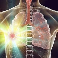 Managing Lung Cancer Patients Through the COVID-19 Pandemic: What to Know