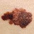 Targeted Therapies Yield Most Promising Results: A New Era in Melanoma Treatment Has Begun