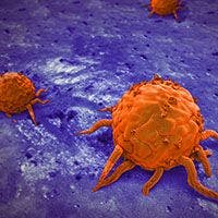Surgery Plus Neoadjuvant Therapy Improves Survival in Margin-Positive Pancreatic Cancer