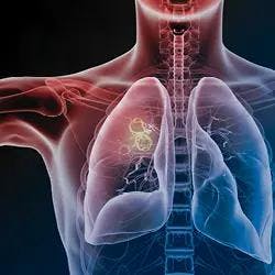 Exploring the Role of Antibody Drug Conjugates in Non-Small Cell Lung Cancer
