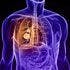 Screening With Low-Dose CT Scan Reduces Deaths From Lung Cancer