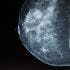 Study Supports Role for ALND in Early Breast Cancer